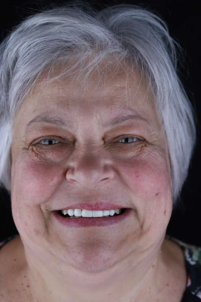 Full arch dental implant patients smiling